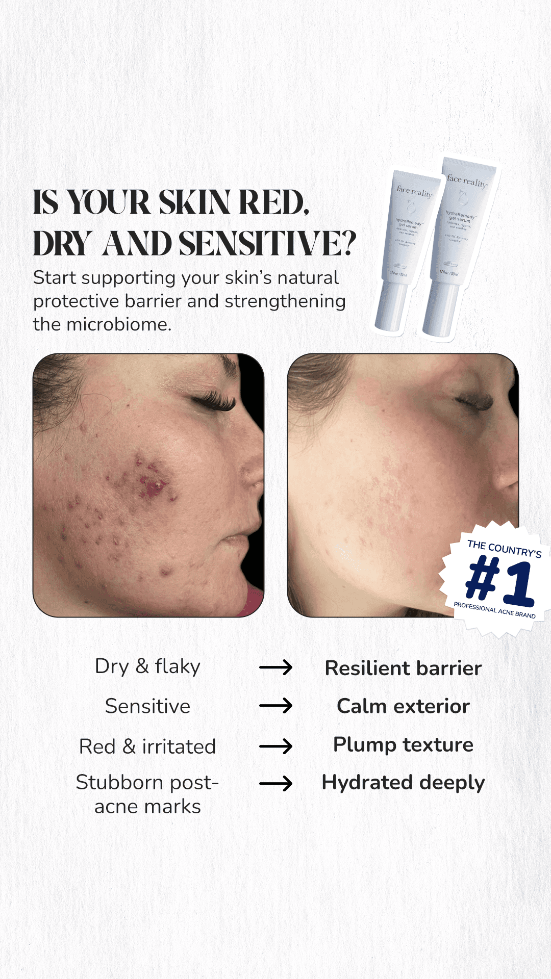 We Love Acne — WLA010-4_Before&After+PainPoints_PA_IMG4