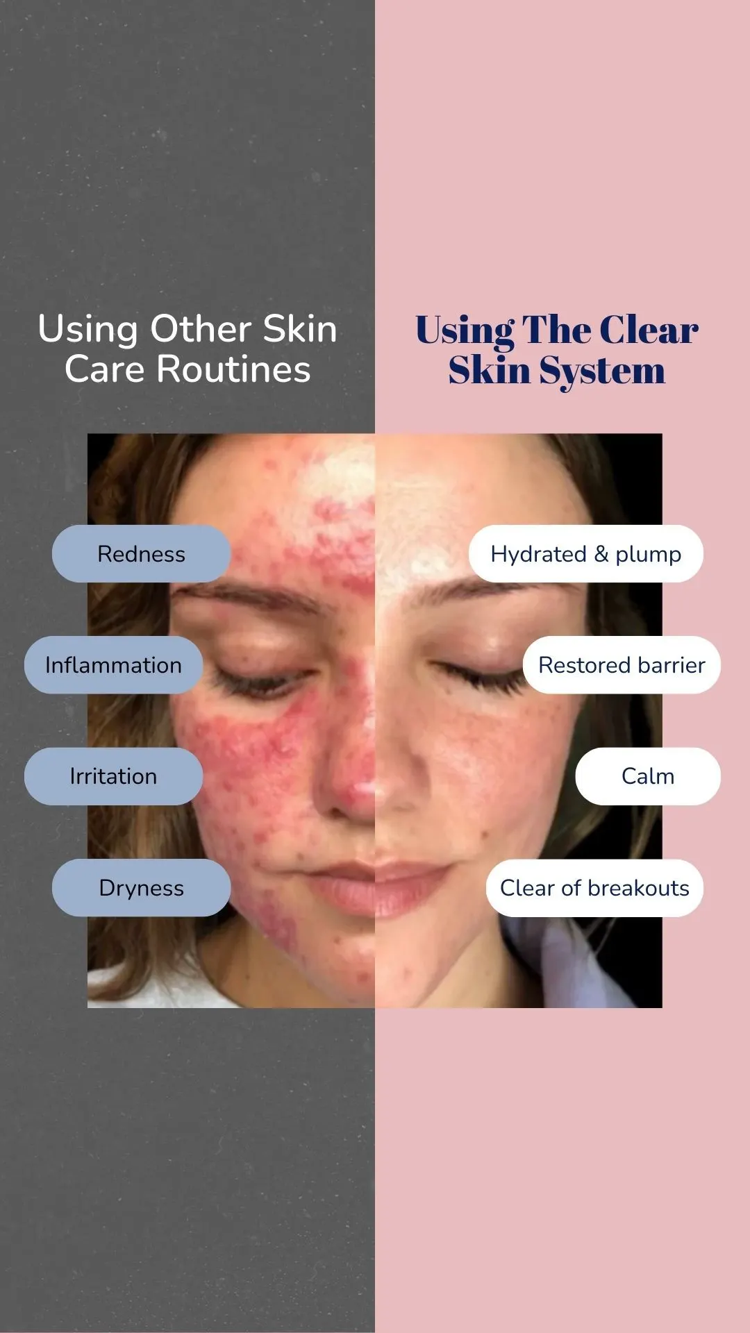 We Love Acne — Meta Ad Creative — Ecom Republic