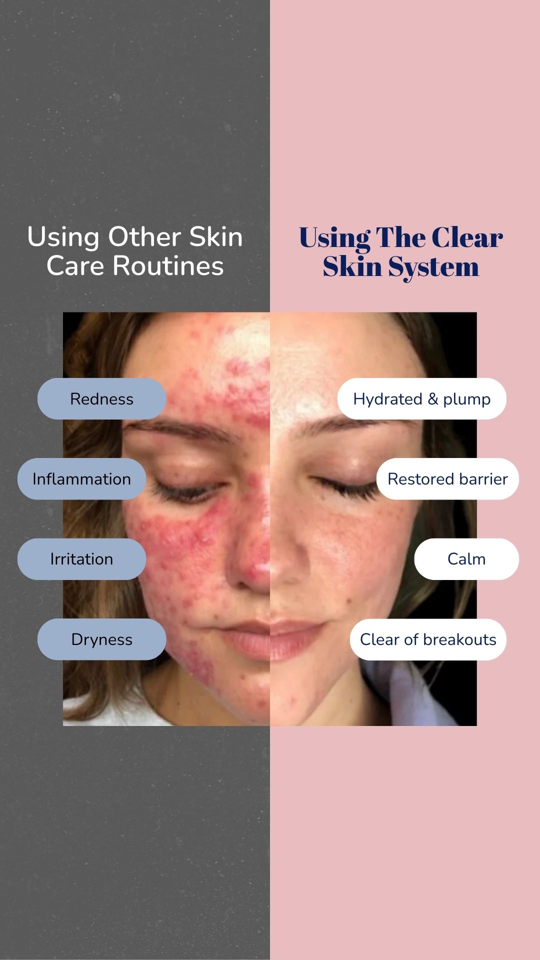 We Love Acne — WLA007-1_SocialProof_PA_IM1_Before&After