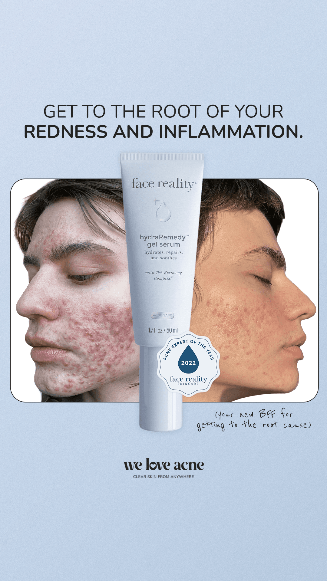 We Love Acne — WLA010-5_Before&After+PainPoints_PA_IMG5