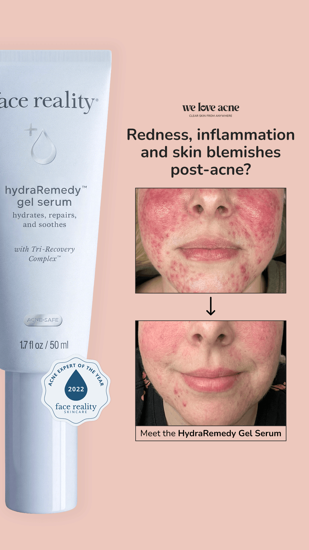 We Love Acne — WLA010-7_Before&After+PainPoints_PA_IMG7