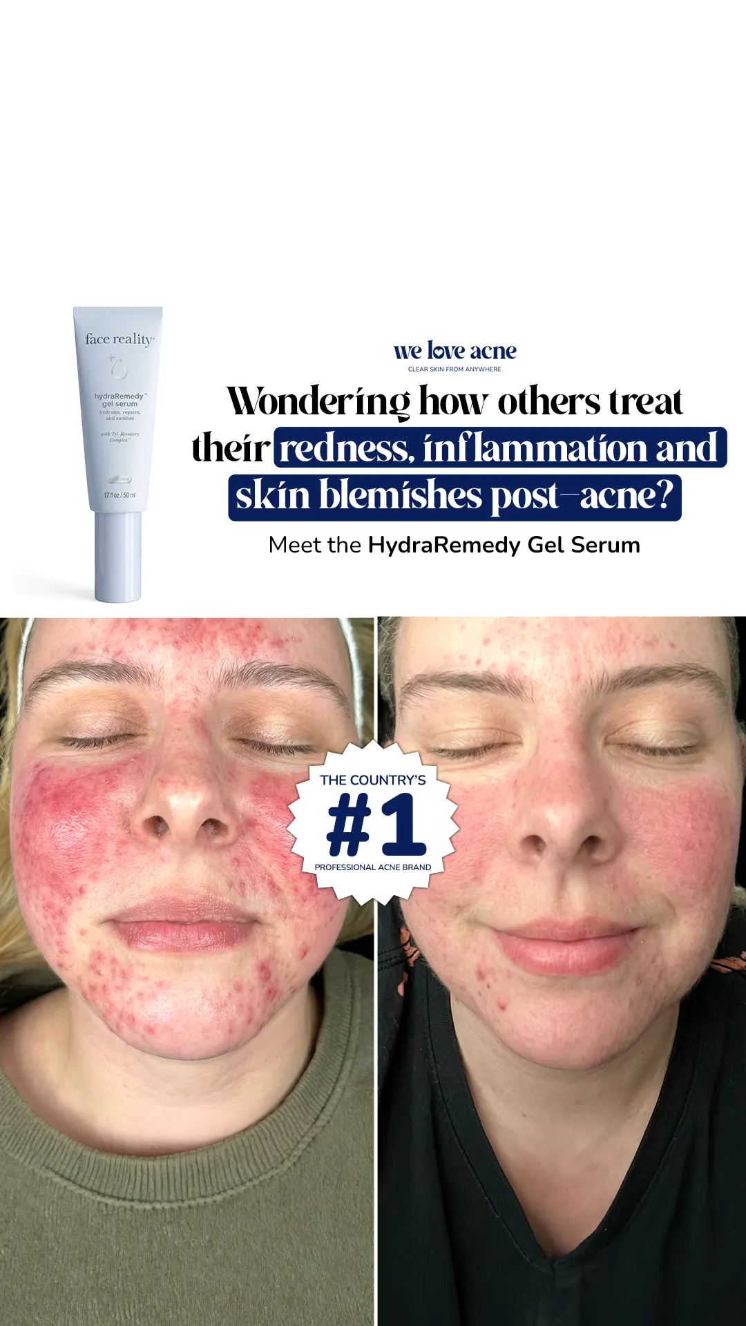 We Love Acne — Meta Ad Creative — Ecom Republic