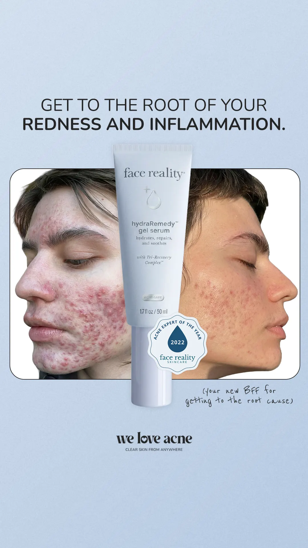We Love Acne — Meta Ad Creative — Ecom Republic